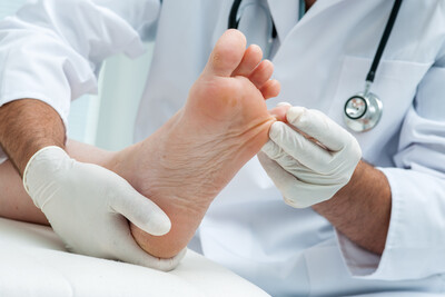 Swift microwave wart treatment