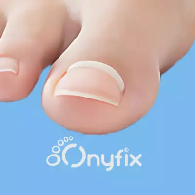 Onyfix ingrown nail brace applied by a chiropodist or podiatrist at our Markham foot clinic