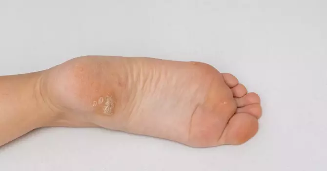 Plantar Warts and Swift Microwave Therapy image